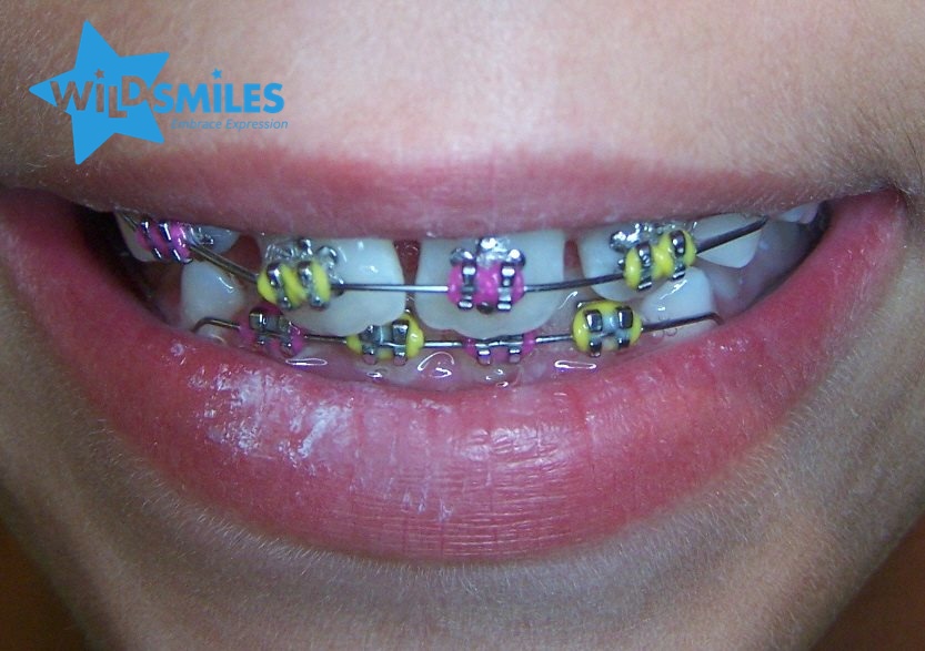 WildSmiles Braces Embrace Your Expression