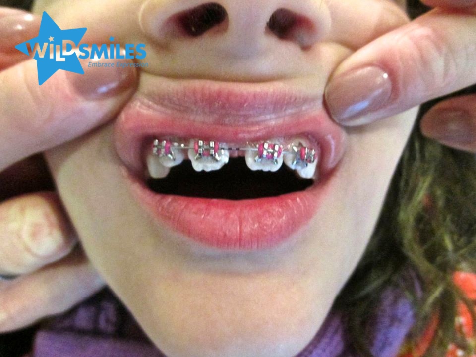 WildSmiles Braces Embrace Your Expression