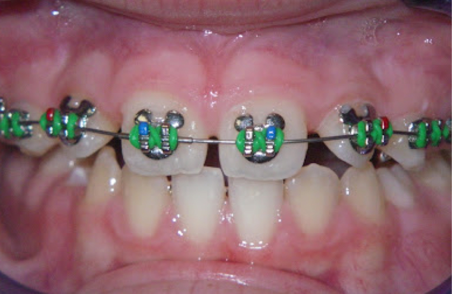 teeth with braces