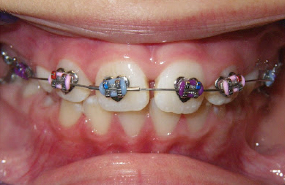 teeth with braces