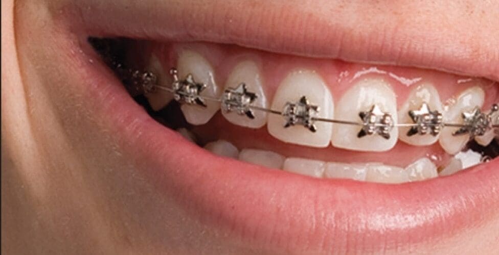 Wild-Smiles-Braces-Bling-976x500
