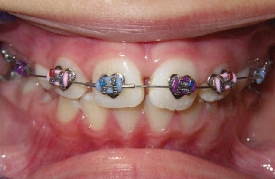 evaluate-brushing-image-2